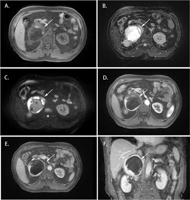 Analysis of characteristics of four patients with adrenal unicentric Castleman disease